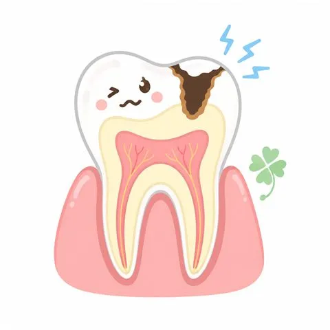C2 象牙質の虫歯のイラスト