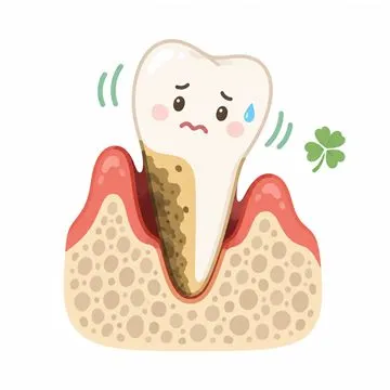 中等度歯周炎のイラスト